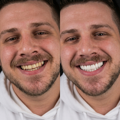 Snaponsmile™- Yeni Gülüşünüz