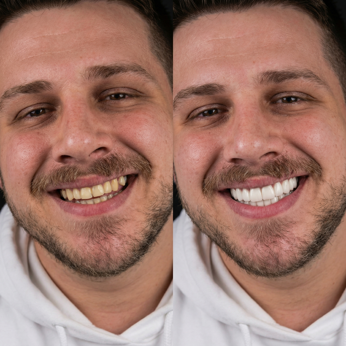 Snaponsmile Diş Kaplama